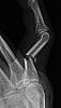 Click image for larger version. 

Name:	displaced_fracture_2.jpg 
Views:	89 
Size:	129.2 KB 
ID:	64973